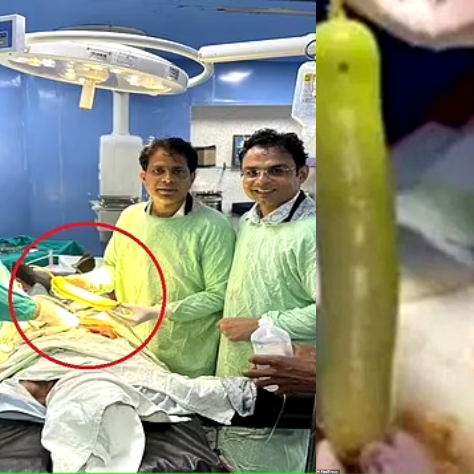 Doctors Remove 18-inch Long Cucumber From Man’s Butt